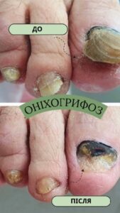 Грифозний ніготь